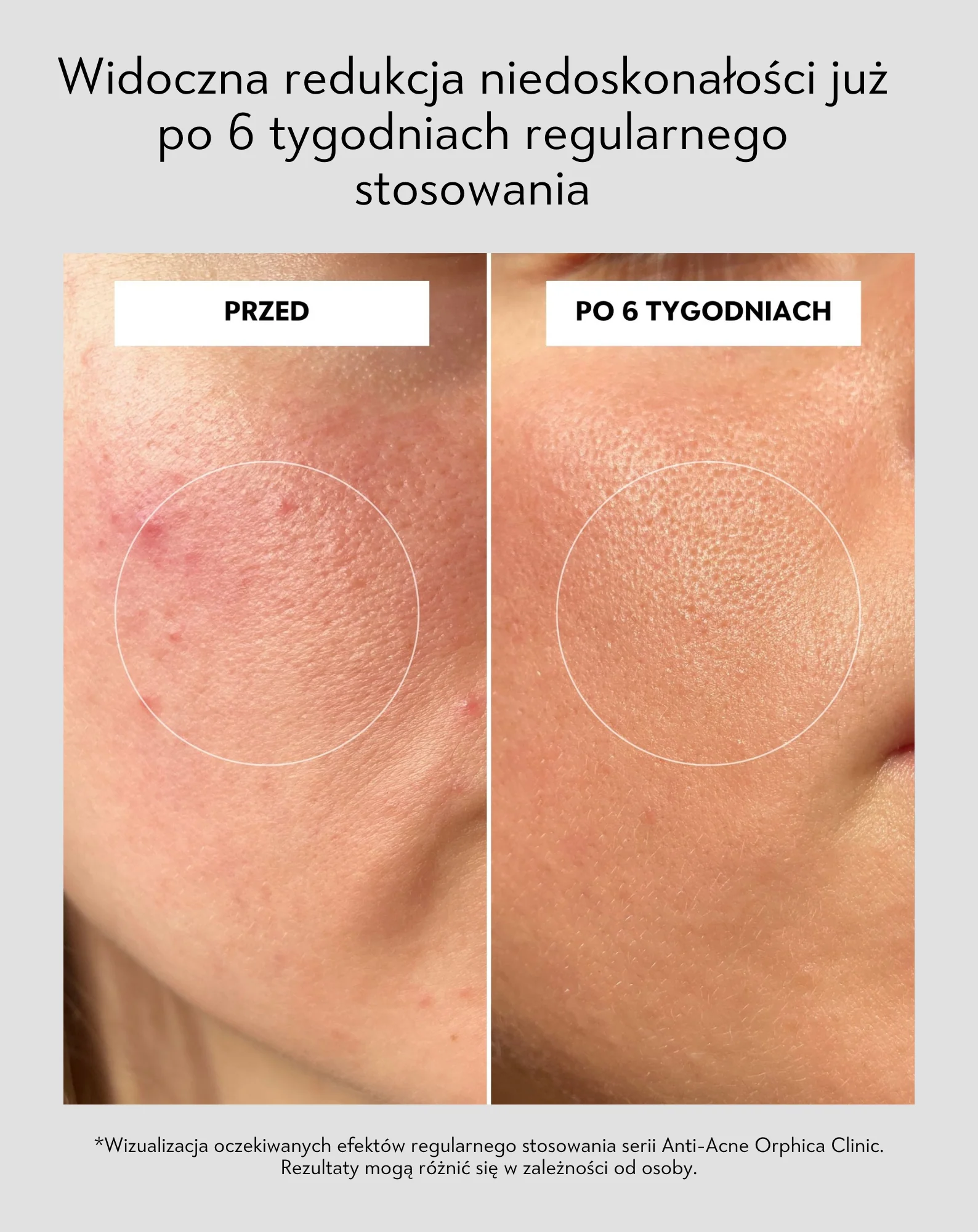 Przeciwtrądzikowy krem na dzień z kwasem salicylowym i azelainowym na niedoskonałości Anti-Acne Orphica Clinic 50 ml - Image 5