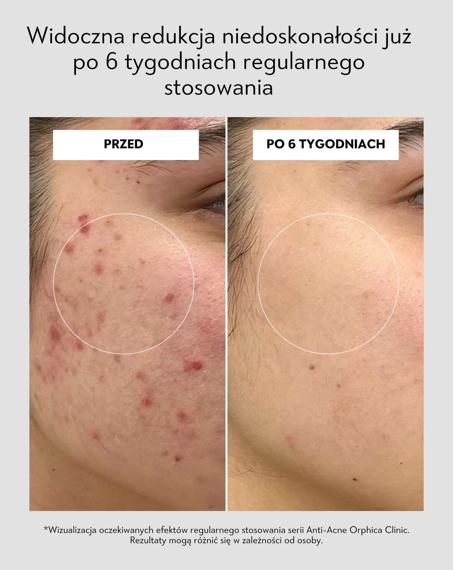 Maska oczyszczająco-regenerująca do cery trądzikowej z białą glinką Anti-Acne Orphica Clinic 100 ml - Image 5