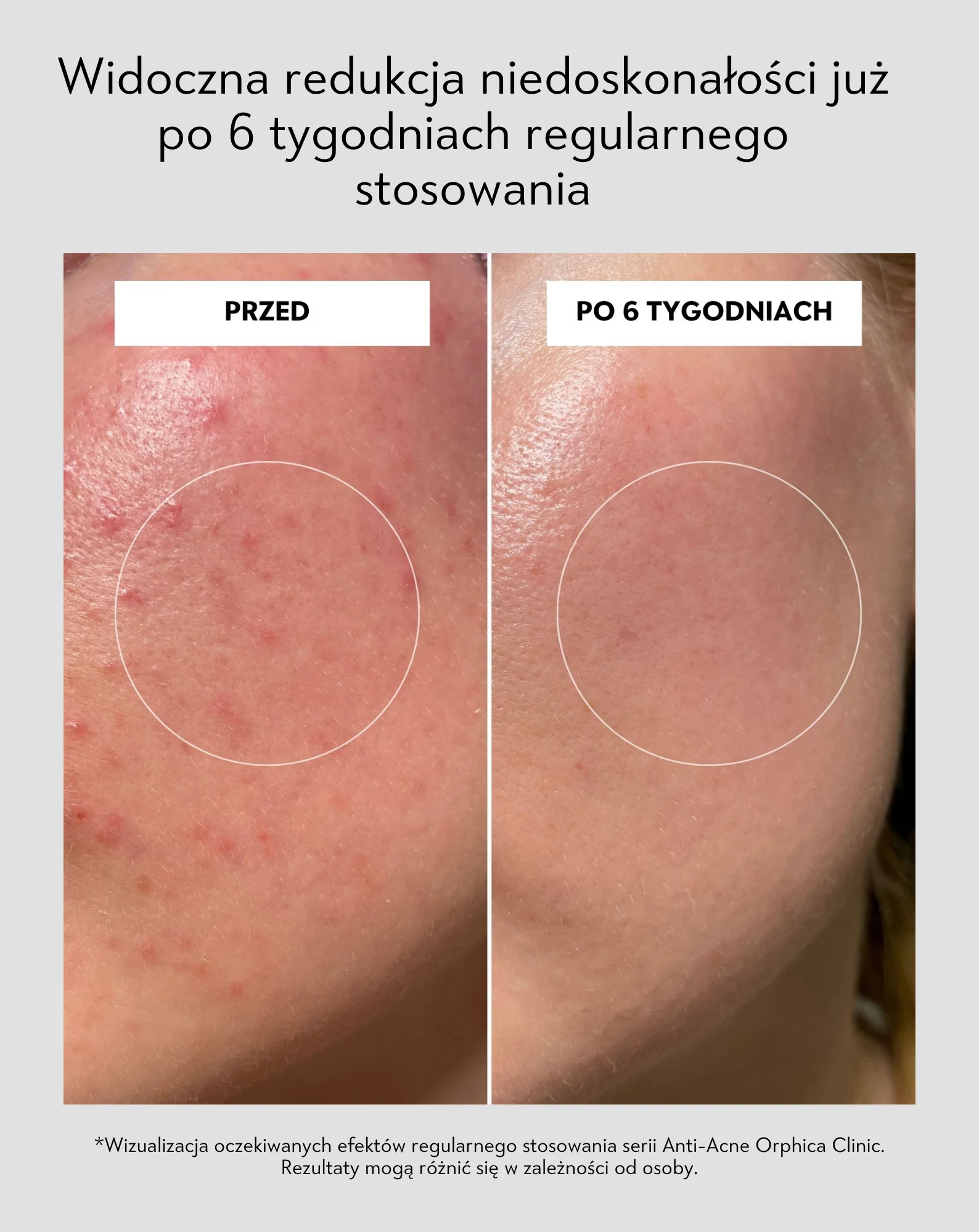 Toner do twarzy na trądzik z niacynamidem i kwasem azelainowym Anti-Acne Orphica Clinic 200 ml - Image 6